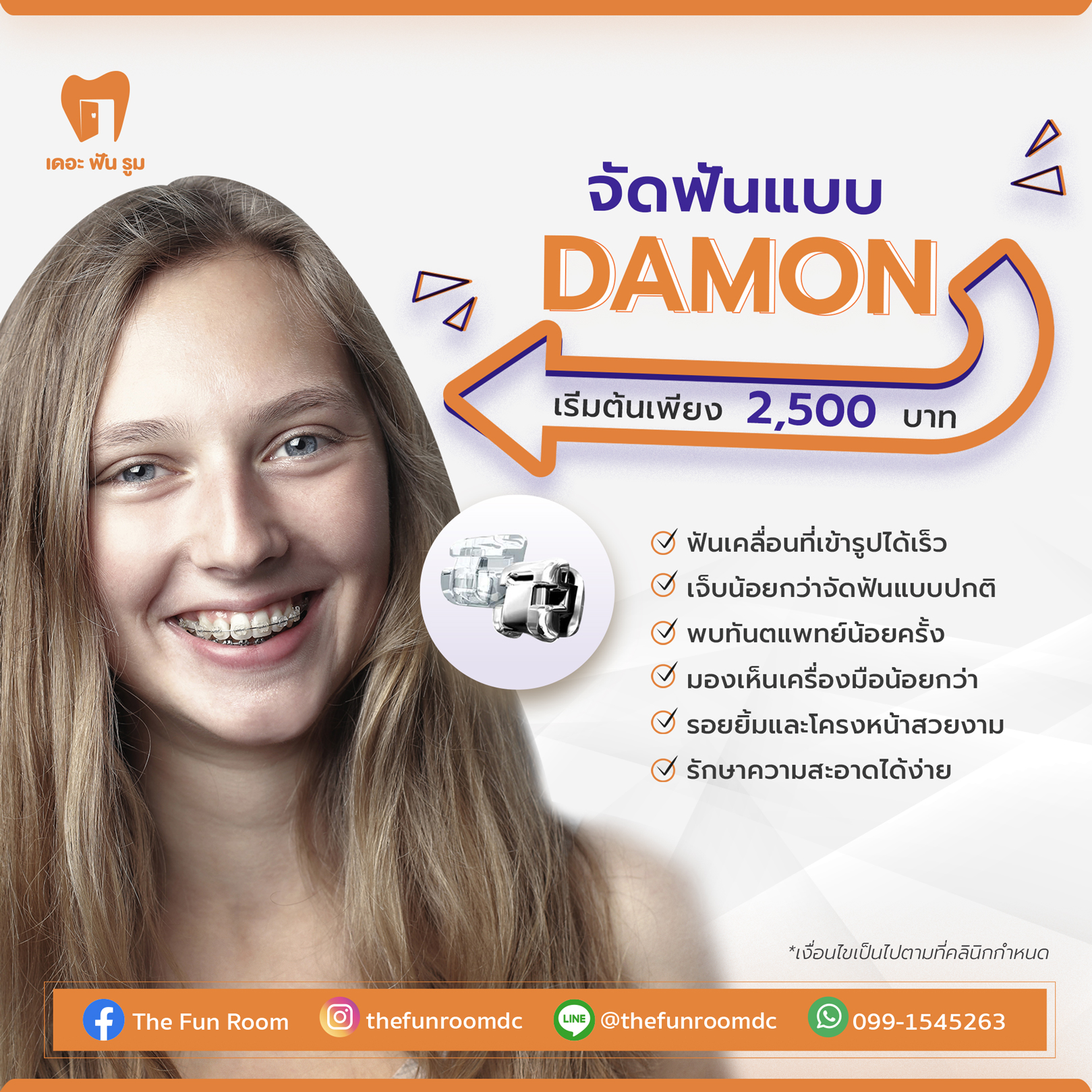 จัดฟันแบบดามอน (Dmon)