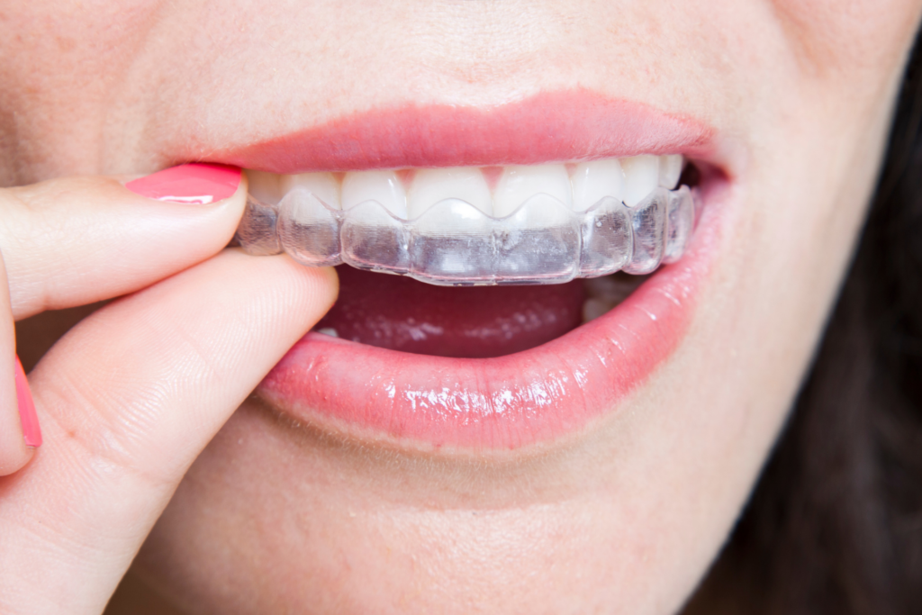 จัดฟันมีกี่แบบ รวมข้อมูลจัดฟัน 5 แบบ (โลหะ, AOSC, ดามอน, Invisalign) เทียบราคา ระยะเวลา และความสะดวก พร้อมแนะนำคลินิกจัดฟัน ลาดกระบัง