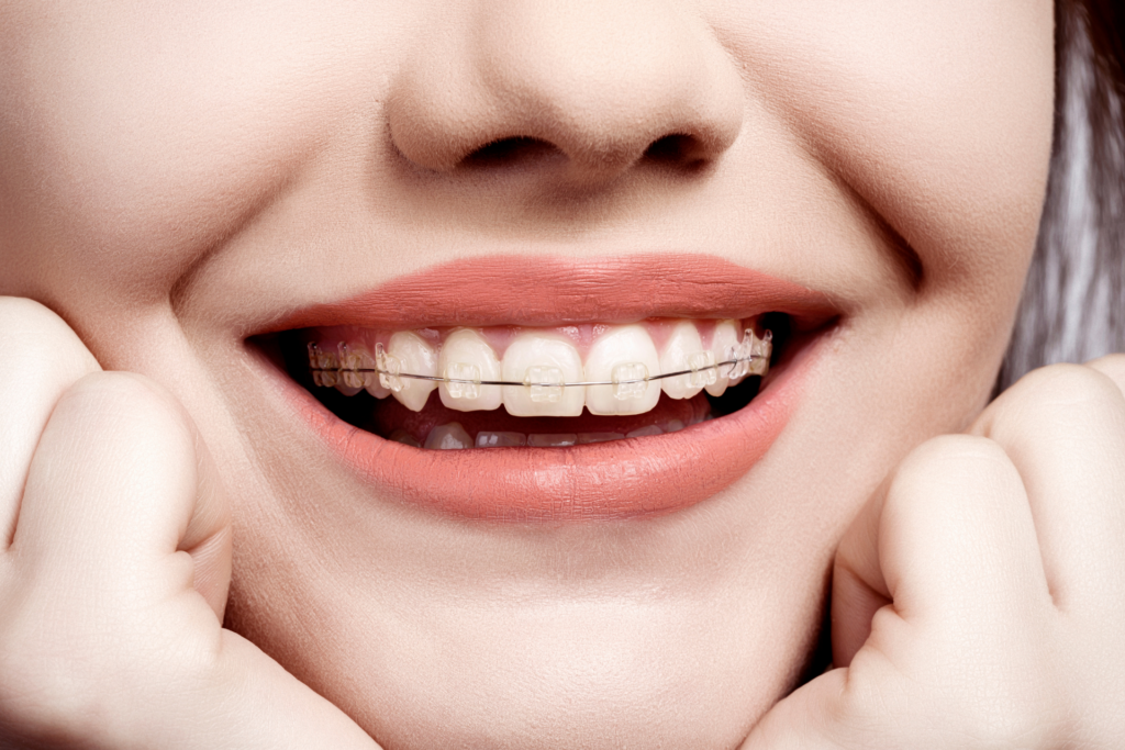 จัดฟันมีกี่แบบ รวมข้อมูลจัดฟัน 5 แบบ (โลหะ, AOSC, ดามอน, Invisalign) เทียบราคา ระยะเวลา และความสะดวก พร้อมแนะนำคลินิกจัดฟัน ลาดกระบัง