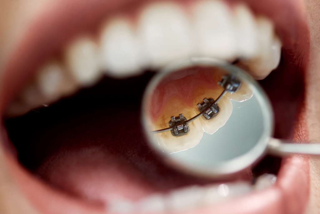 จัดฟัน แต่ไม่รู้จะเริ่มตรงไหน? เจาะลึกทุกประเภทการจัดฟัน โลหะ, ดามอน และ Invisalign พร้อมเช็กราคา โปรโมชั่น และขั้นตอนการเตรียมตัวฉบับมือใหม่ที่ The Fun Room Clinic