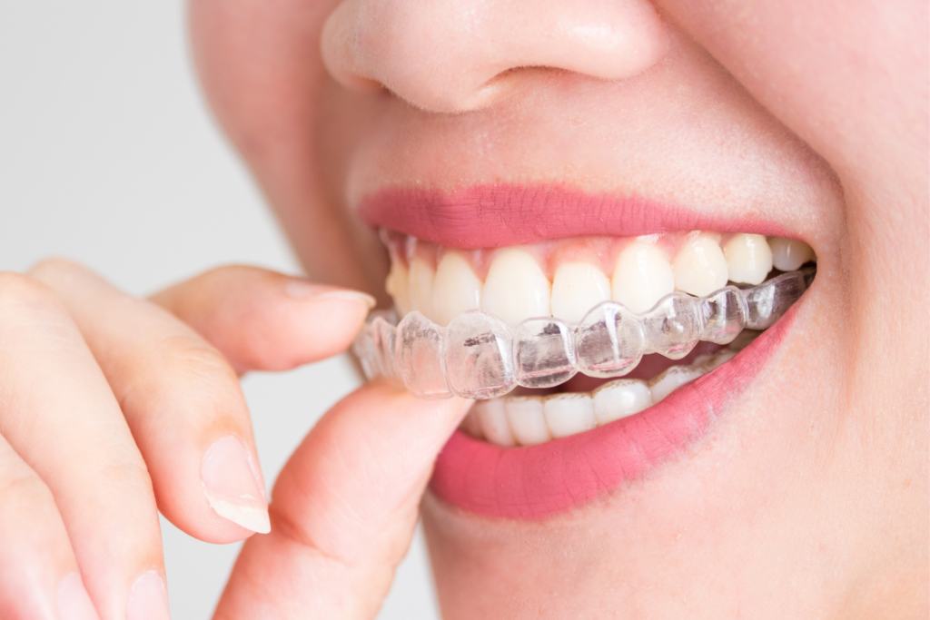จัดฟันมีกี่แบบ รวมข้อมูลจัดฟัน 5 แบบ (โลหะ, AOSC, ดามอน, Invisalign) เทียบราคา ระยะเวลา และความสะดวก พร้อมแนะนำคลินิกจัดฟัน ลาดกระบัง