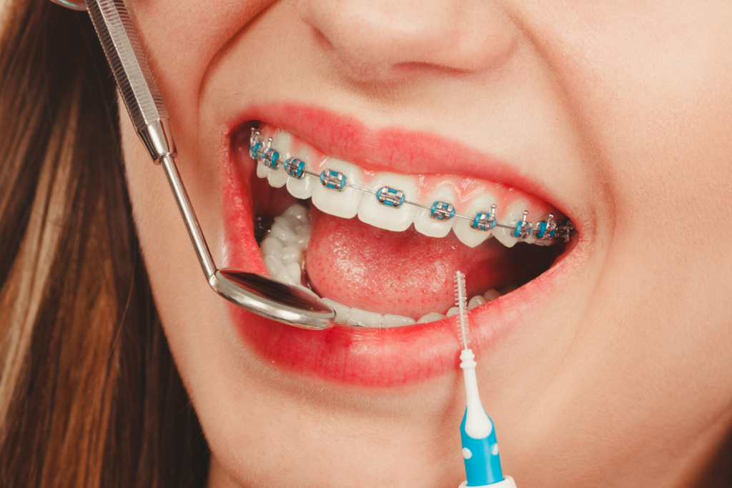 เจาะลึกความต่างจัดฟันใส Invisalign vs จัดฟันแบบเหล็ก ราคาจัดฟัน 2026 และวิธีเลือกให้เข้ากับไลฟ์สไตล์คุณที่ คลินิกจัดฟัน ลาดกระบัง