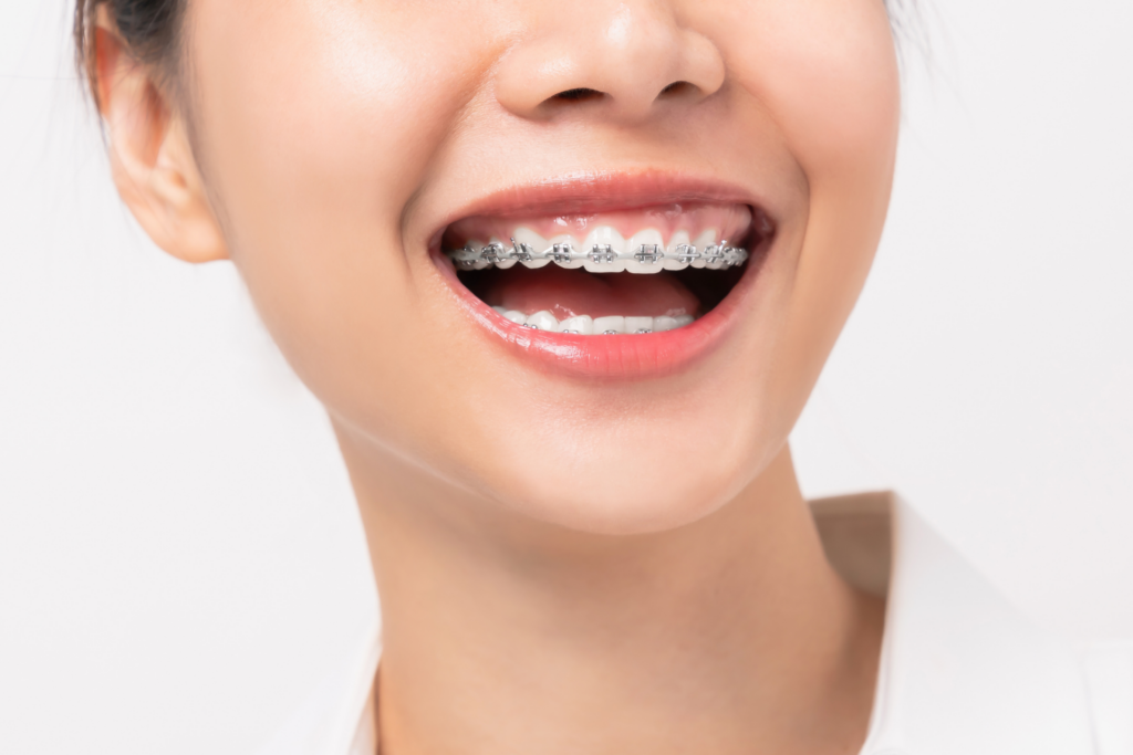 เจาะลึกความต่างจัดฟันใส Invisalign vs จัดฟันแบบเหล็ก ราคาจัดฟัน 2026 และวิธีเลือกให้เข้ากับไลฟ์สไตล์คุณที่ คลินิกจัดฟัน ลาดกระบัง