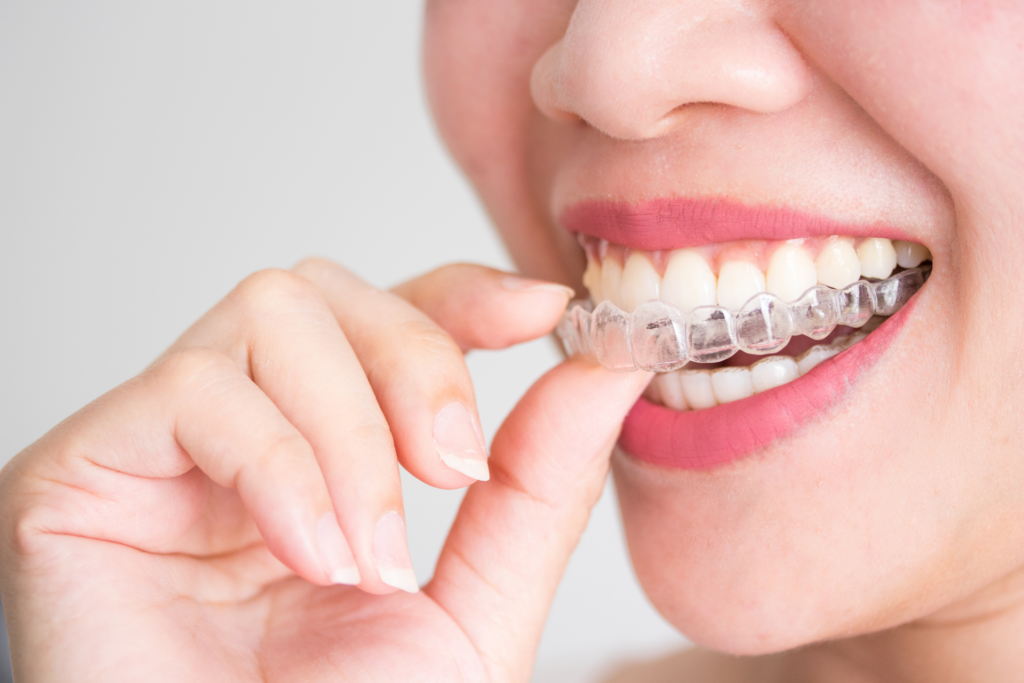 เจาะลึกความต่างจัดฟันใส Invisalign vs จัดฟันแบบเหล็ก ราคาจัดฟัน 2026 และวิธีเลือกให้เข้ากับไลฟ์สไตล์คุณที่ คลินิกจัดฟัน ลาดกระบัง