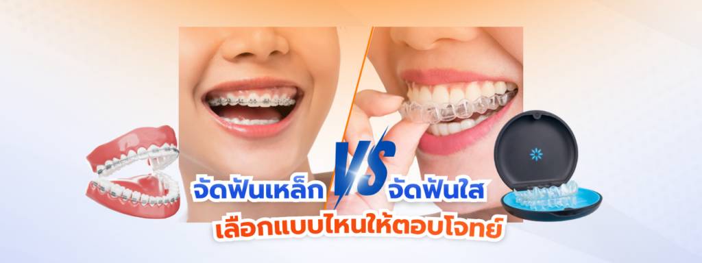 เจาะลึกความต่างจัดฟันใส Invisalign vs จัดฟันแบบเหล็ก ราคาจัดฟัน 2026 และวิธีเลือกให้เข้ากับไลฟ์สไตล์คุณที่ คลินิกจัดฟัน ลาดกระบัง