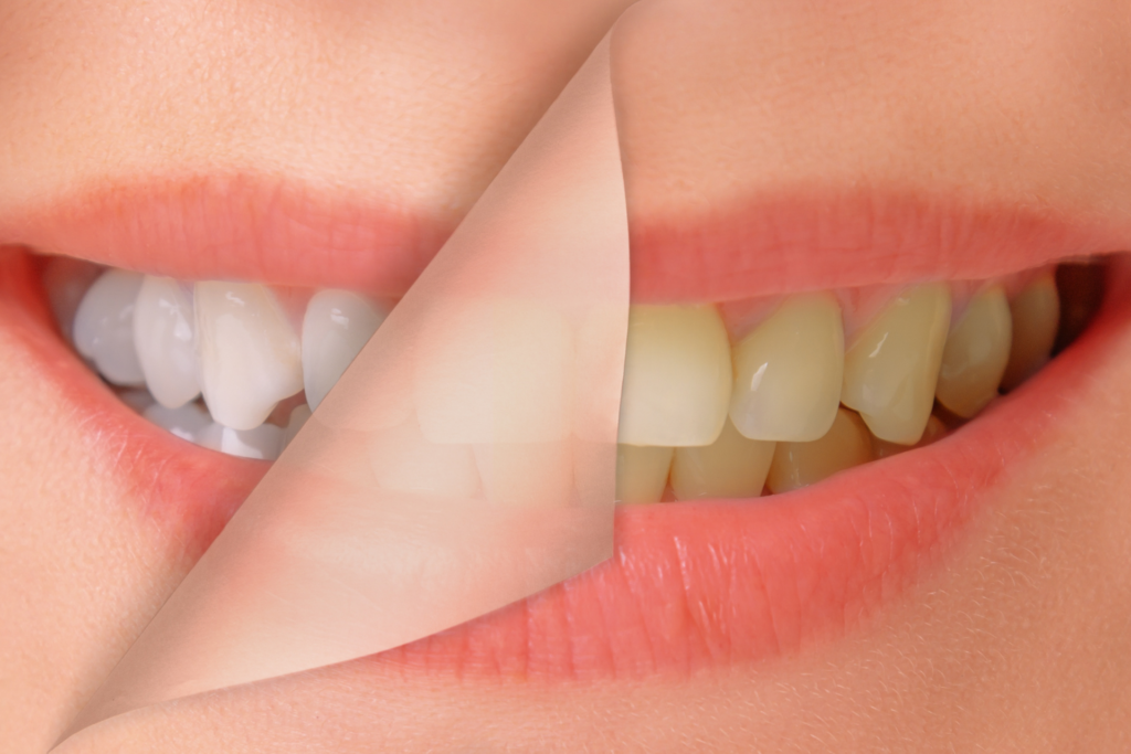คู่มือ ฟอกสีฟัน ฉบับสมบูรณ์ เจาะลึกระบบ Cool Light และ Home Whitening พร้อมเทคนิคการล็อกความขาวและเช็กราคาปี 2026 ที่ คลินิกทำฟัน ลาดกระบัง