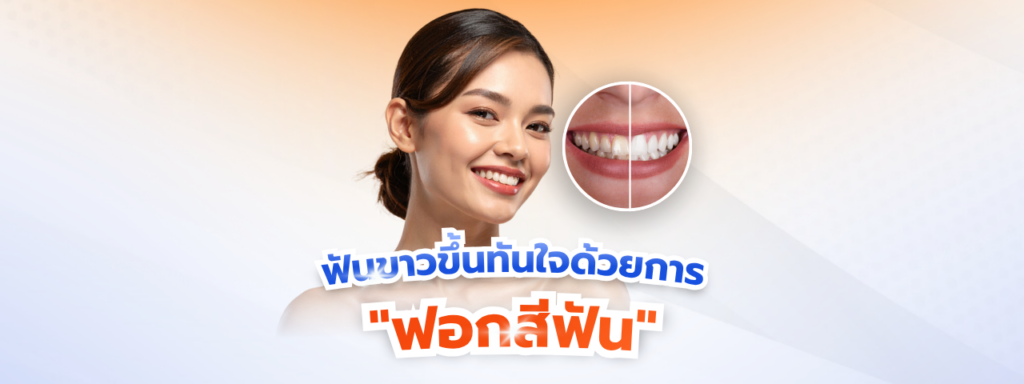 ฟันขาวขึ้นทันใจด้วยการ “ฟอกสีฟัน” สรุปทุกขั้นตอนและวิธีคงความขาวให้ยาวนานระดับพรีเมียม