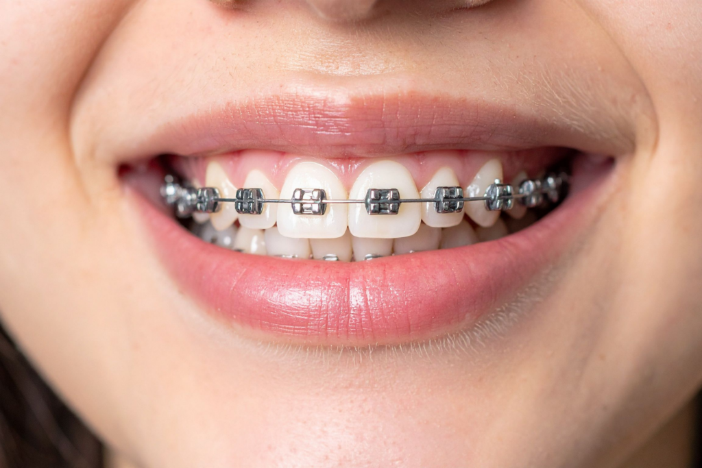 จัดฟันมีกี่แบบ? จัดฟันแบบไหนดี ทั้ง 5 แบบ ทั้งโลหะ AOSC Damon Clear Aligner และ Invisalign พร้อมข้อดี-ข้อด้อย 