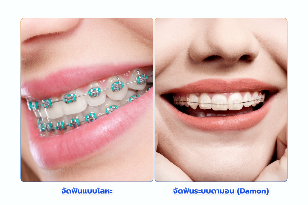 เปรียบเทียบ จัดฟันแบบโลหะ vs จัดฟันแบบดามอน (Damon) ครบทุกมิติ ทั้งกลไก ความเจ็บ ระยะเวลา การดูแล และความคุ้มค่า