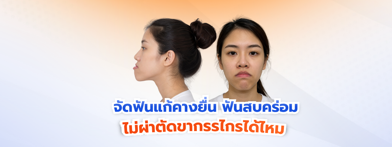 จัดฟันแก้คางยื่น ฟันสบคร่อม (Underbite) ได้ไหม? โดยไม่ต้องผ่าตัดขากรรไกร
