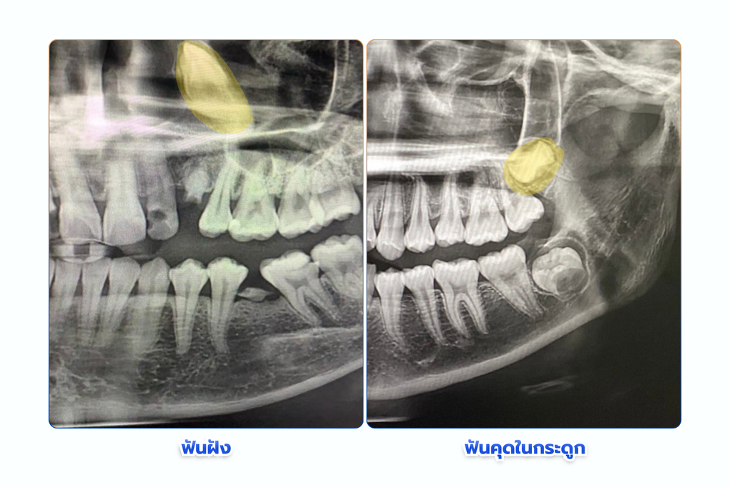 ฟันคุดในกระดูก แต่ไม่ปวด ปล่อยไว้ได้ไหม? เจาะลึกสาเหตุ ภัยเงียบ พร้อมวิธีดูแลตัวเองหลังผ่า ที่ The Fun Room ลาดกระบัง