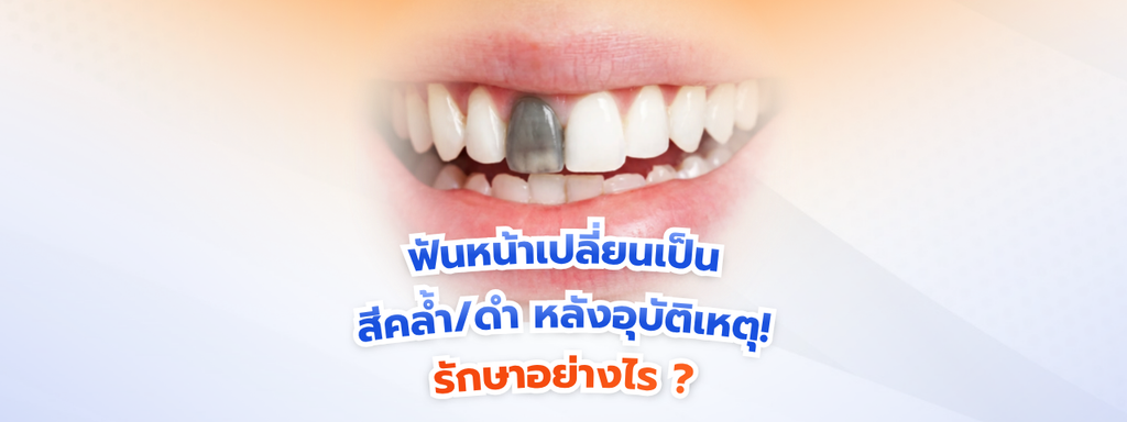 ฟันหน้าเปลี่ยนสีเป็นสีคล้ำ/ดำ หลังอุบัติเหตุ! วิธีแก้ด้วยการรักษารากฟันร่วมกับฟอกสีฟันเฉพาะซี่ (Internal Bleaching)