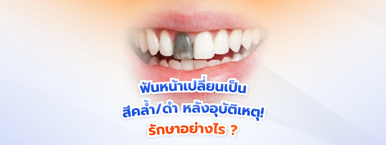 ฟันหน้าเปลี่ยนสีเป็นสีคล้ำ/ดำ หลังอุบัติเหตุ! วิธีแก้ด้วยการรักษารากฟันร่วมกับฟอกสีฟันเฉพาะซี่ (Internal Bleaching)