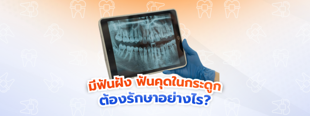 มีฟันฝัง ฟันคุดในกระดูก ต้องรักษาอย่างไร? เจาะลึกวิธีรับมือพร้อมคืนรอยยิ้มอย่างปลอดภัย