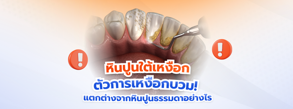 หินปูนใต้เหงือก (Subgingival Calculus) ตัวการเหงือกบวมเลือดออก! แตกต่างจากหินปูนธรรมดาอย่างไร?