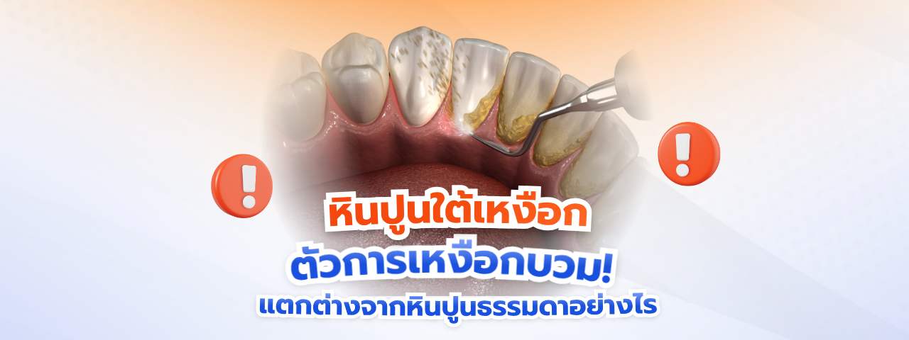 หินปูนใต้เหงือก (Subgingival Calculus) ตัวการเหงือกบวมเลือดออก! แตกต่างจากหินปูนธรรมดาอย่างไร?