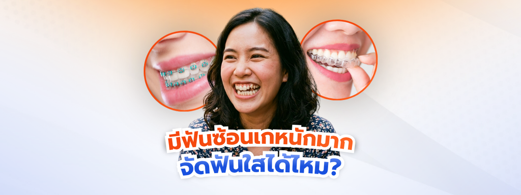 ฟันซ้อนเกหนักมาก จัดฟันใส ได้ไหม เจ็บไหม ใช้เวลากี่เดือน ที่ The Fun Room ลาดกระบัง
