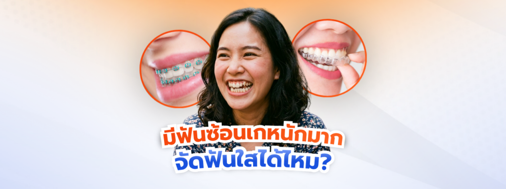 มีฟันซ้อนเกหนักมาก จัดฟันใสได้ไหม?