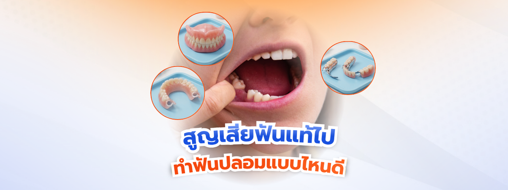สูญเสียฟันแท้ไป ทำฟันปลอมแบบไหนดี? เจาะลึก รากฟันเทียม VS สะพานฟัน VS ฟันปลอมถอดได้