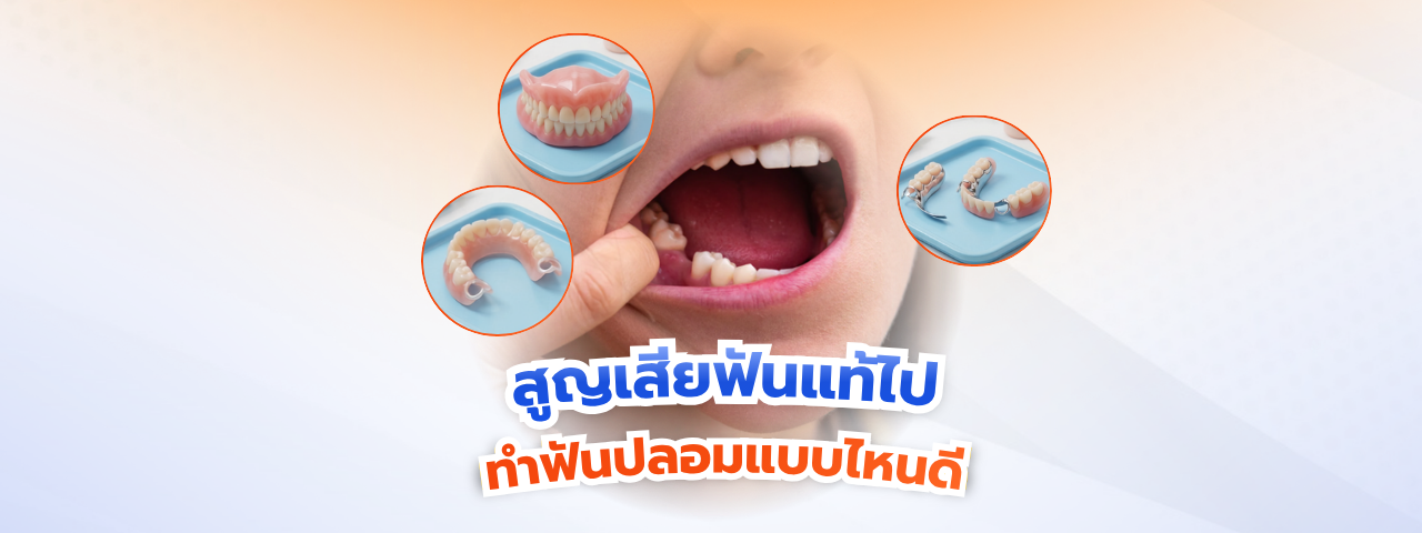 สูญเสียฟันแท้ไป ทำฟันปลอมแบบไหนดี? เจาะลึก รากฟันเทียม VS สะพานฟัน VS ฟันปลอมถอดได้