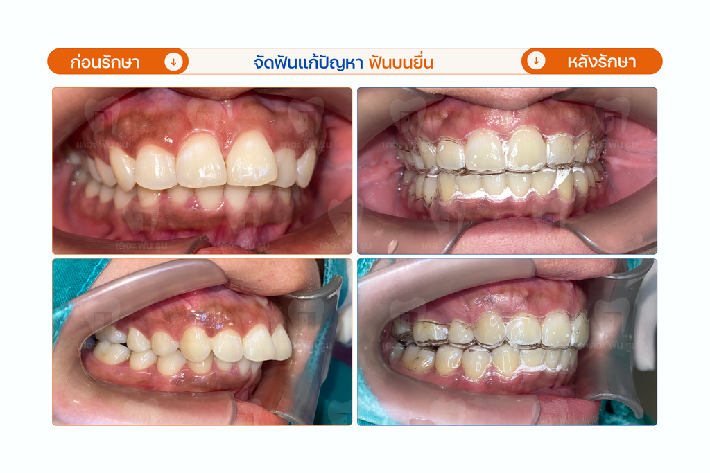 ฟันยื่น ฟันเหยิน ฟันสบคร่อม จัดฟันเปลี่ยนโครงหน้า ให้เข้าที่ได้จริงไหม? เจาะลึกกลไกที่ฟันเคลื่อนแล้วริมฝีปาก คาง และโครงหน้าเปลี่ยนตาม 