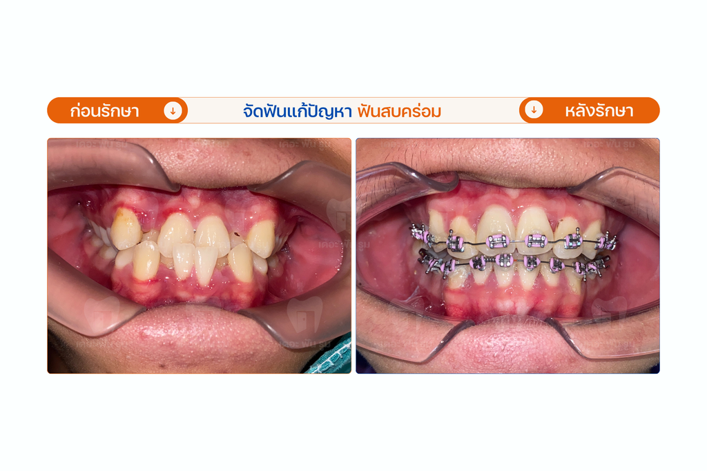 ฟันยื่น ฟันเหยิน ฟันสบคร่อม จัดฟันเปลี่ยนโครงหน้า ให้เข้าที่ได้จริงไหม? เจาะลึกกลไกที่ฟันเคลื่อนแล้วริมฝีปาก คาง และโครงหน้าเปลี่ยนตาม 