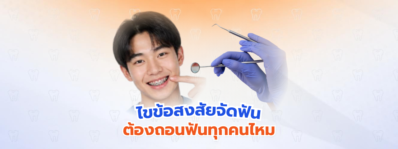 ไขข้อสงสัย “จัดฟันต้องถอนฟันทุกคนไหม” เคสแบบไหนจัดฟันโดยไม่ต้องถอนฟันได้